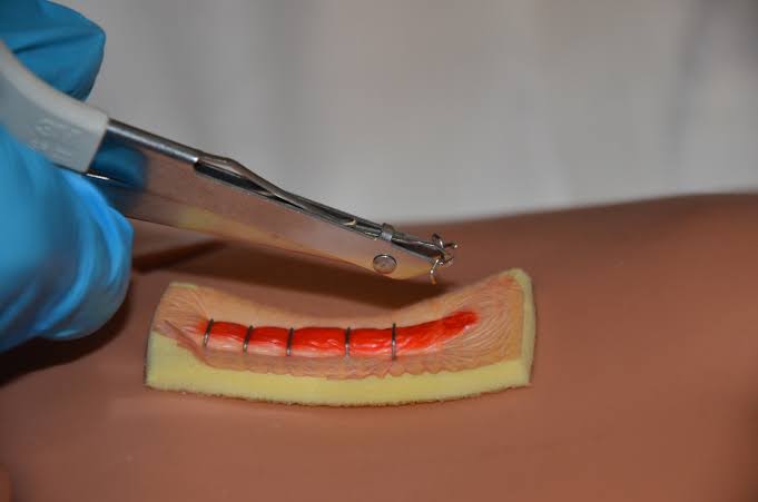 Suture & Staple Removal - Velura Clinic
